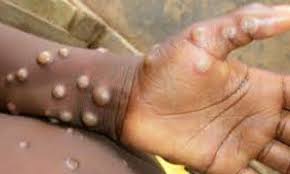 Abia state records first Monkey pox case