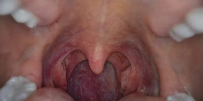 Throat Cancer linked to HPV and Oral Sex Credit Healthcare