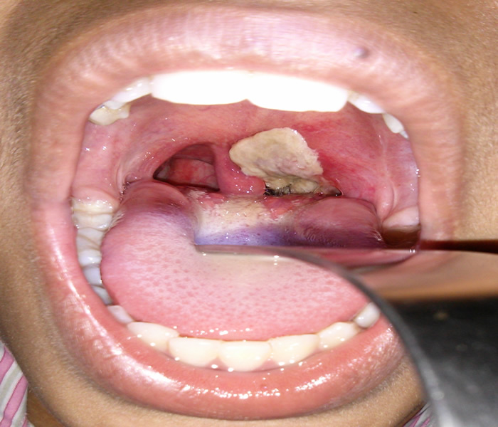 A case of Diphtheria Infection